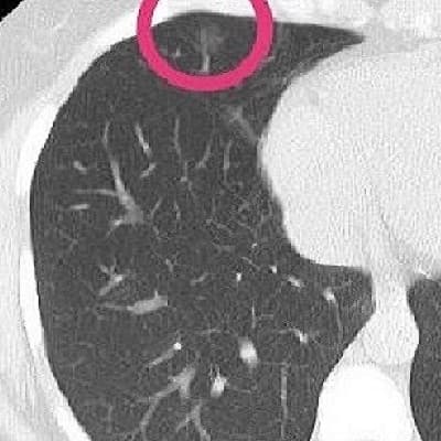 I3DR-Net: AI based Lung Nodule Detection